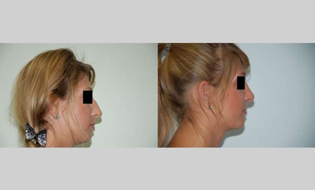 Nose Surgery: Image #158