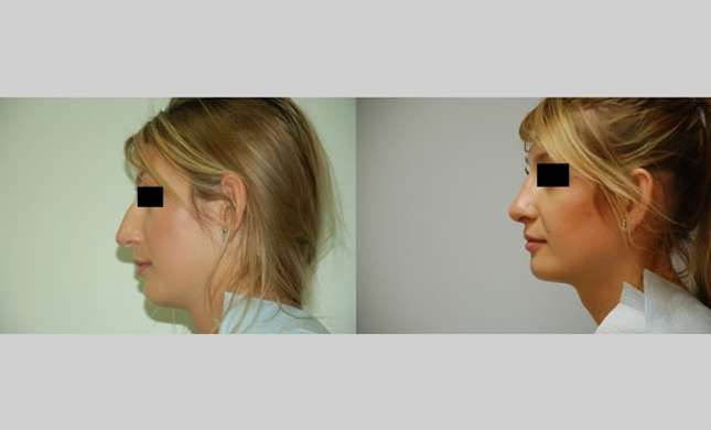 Nose Surgery: Image #159