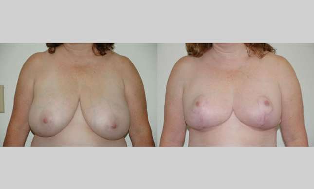 Breast Reduction: Image #160