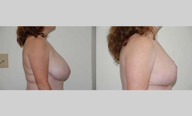 Breast Reduction: Image #161