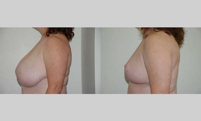 Breast Reduction: Image #162