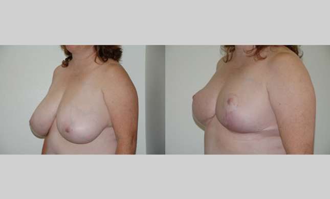 Breast Reduction: Image #163