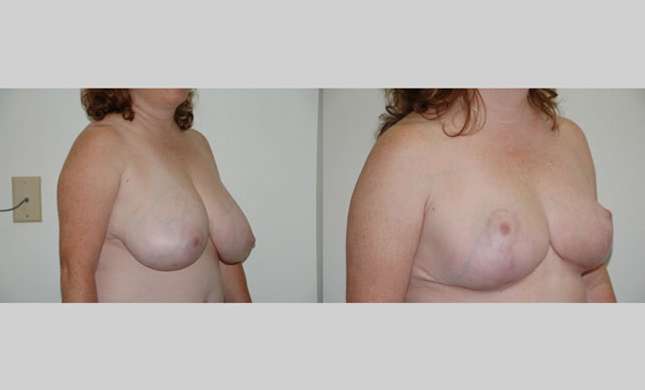 Breast Reduction: Image #164