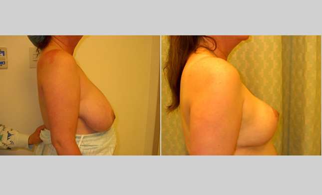 Breast Reduction: Image #165