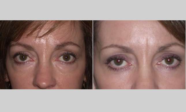 Eyelid Surgery: Image #207