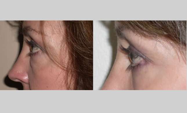 Eyelid Surgery: Image #208