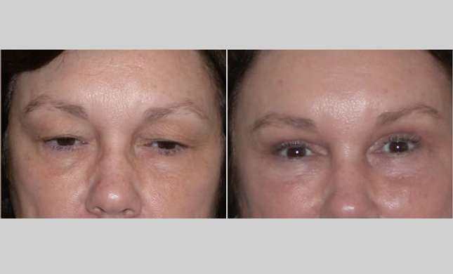 Eyelid Surgery: Image #209