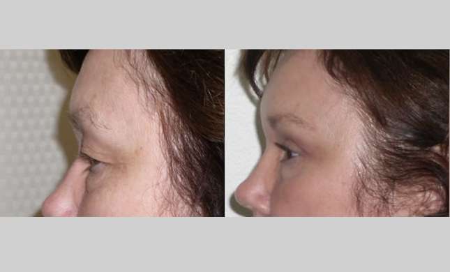 Eyelid Surgery: Image #210