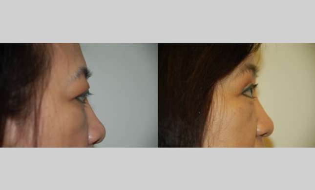 Eyelid Surgery: Image #211