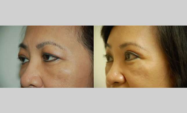 Eyelid Surgery: Image #212