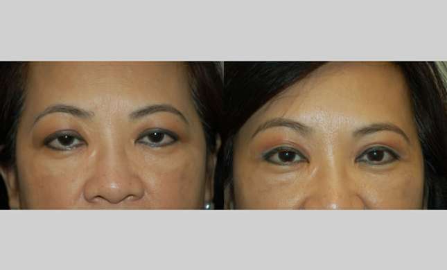 Eyelid Surgery: Image #214