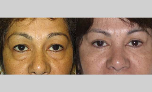 Eyelid Surgery: Image #215