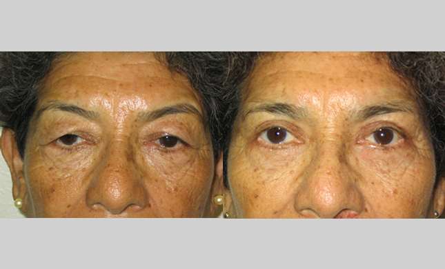 Eyelid Surgery: Image #216