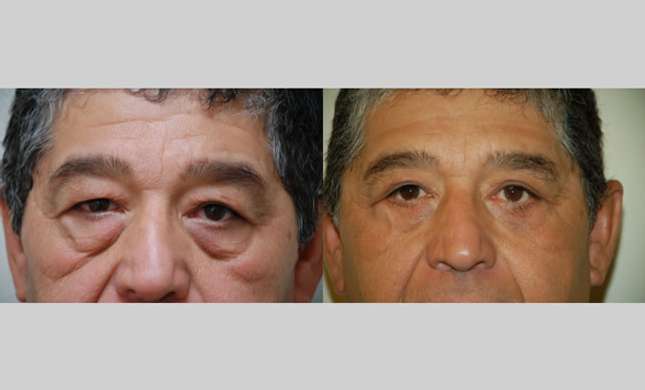 Eyelid Surgery: Image #217