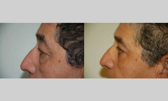 Eyelid Surgery: Image #218