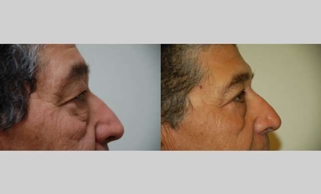 Eyelid Surgery: Image #219