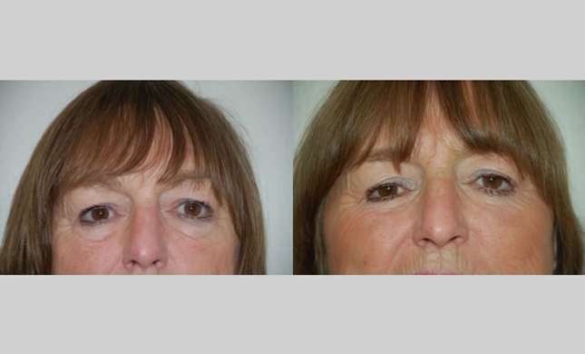 Eyelid Surgery: Image #220