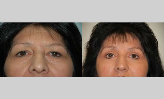 Eyelid Surgery: Image #221