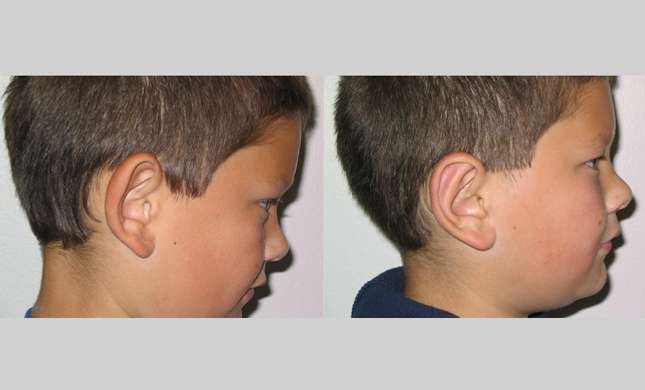 Ear Surgery: Image #224