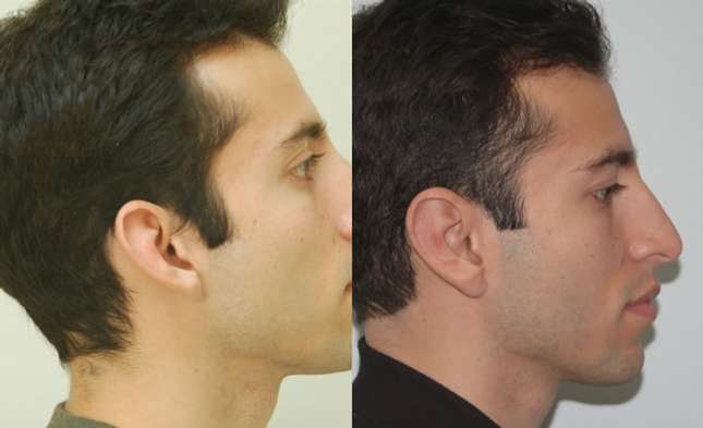 Ear Surgery: Image #226