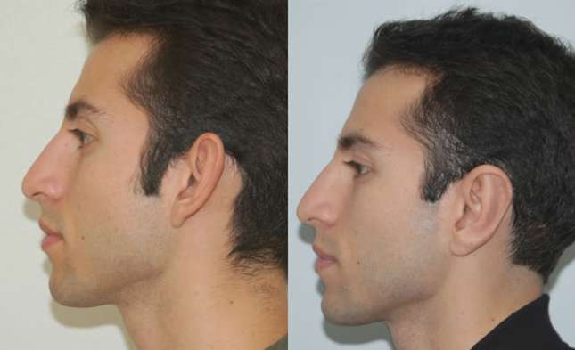 Ear Surgery: Image #227