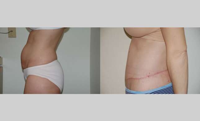 Body Lift: Image #229