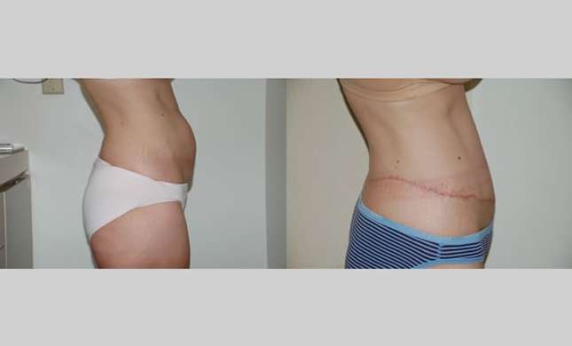 Body Lift: Image #230