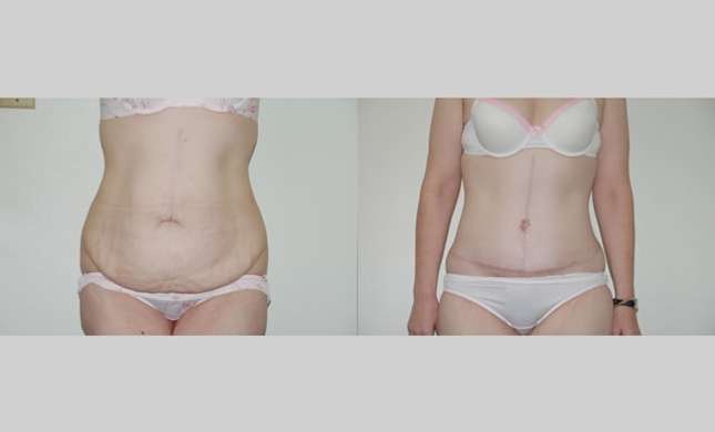 Body Lift: Image #231