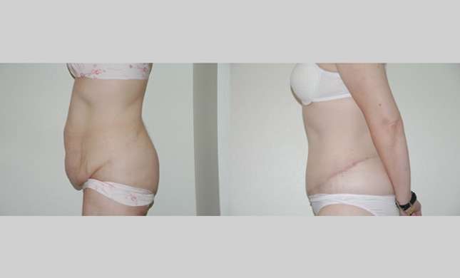 Body Lift: Image #232