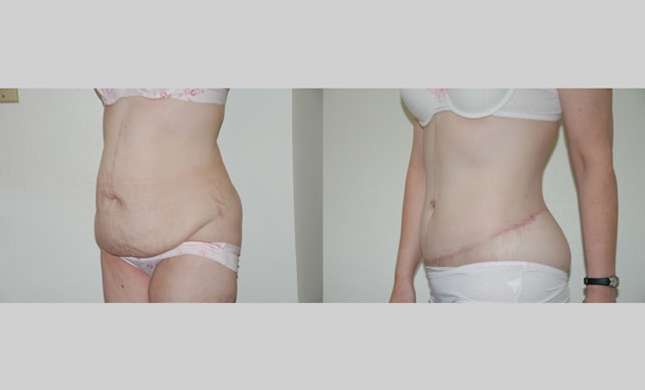 Body Lift: Image #233