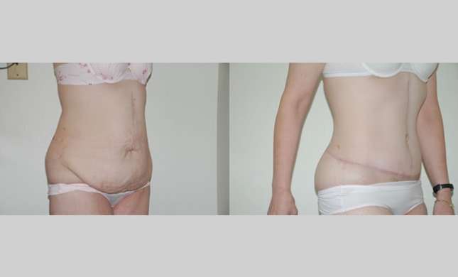 Body Lift: Image #234