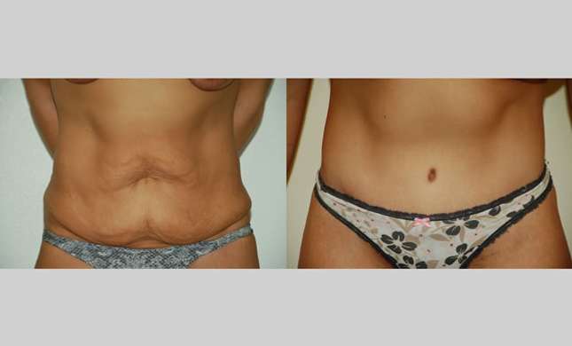 Body Lift: Image #235