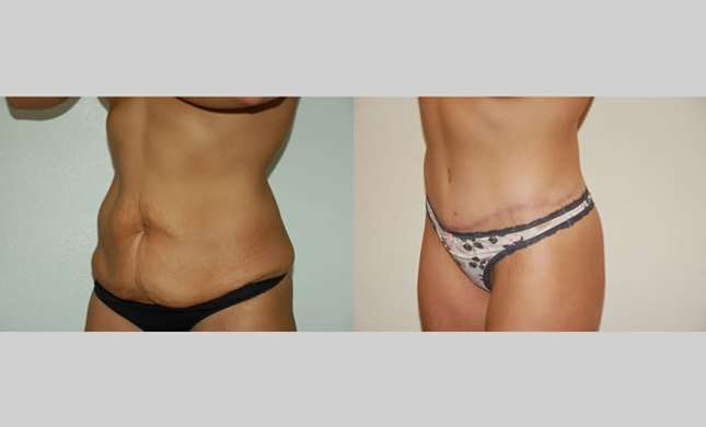 Body Lift: Image #237