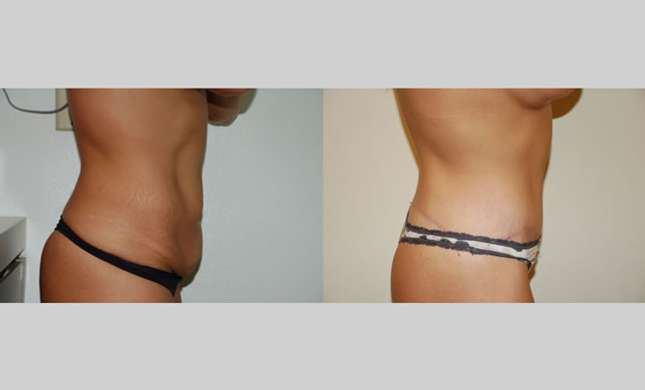 Body Lift: Image #238