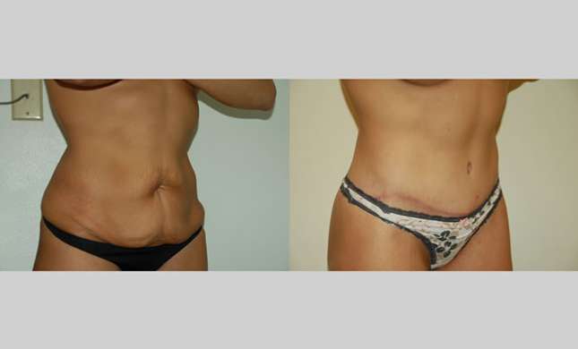 Body Lift: Image #239