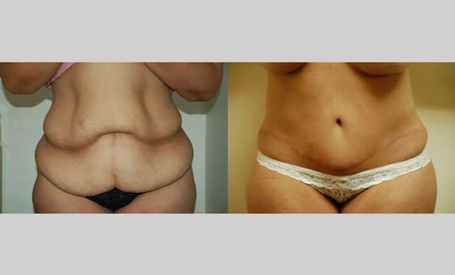 Body Lift: Image #241
