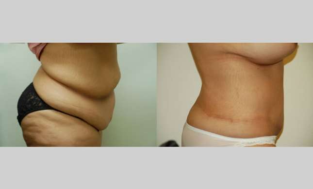 Body Lift: Image #242