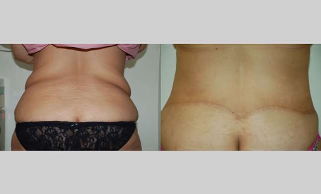 Body Lift: Image #243