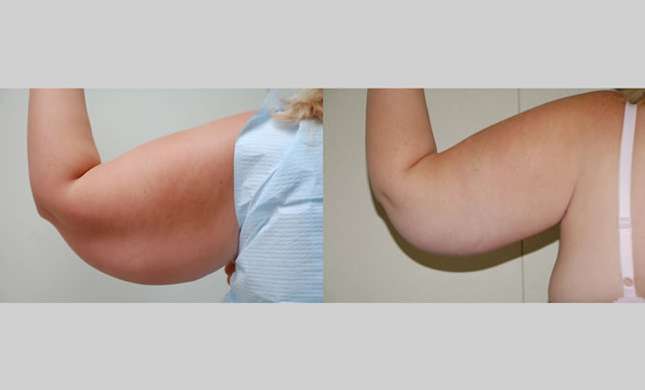 Upper Arm Lift: Image #244