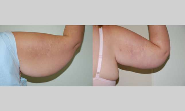 Upper Arm Lift: Image #245