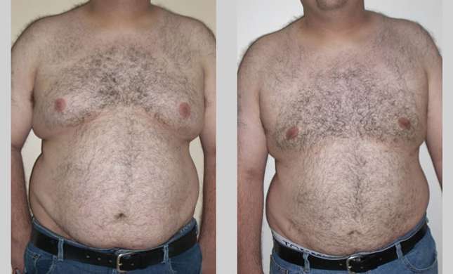 Male Breast Reduction: Image #247