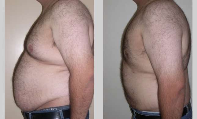 Male Breast Reduction: Image #248