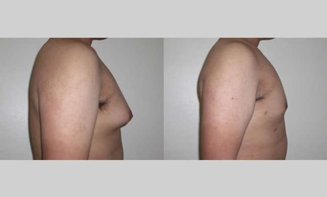 Male Breast Reduction: Image #249