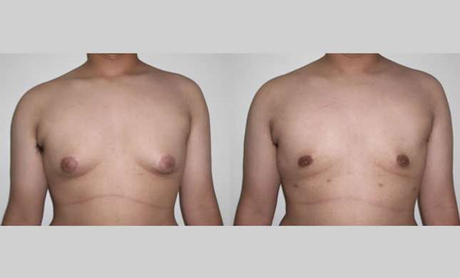 Male Breast Reduction: Image #250