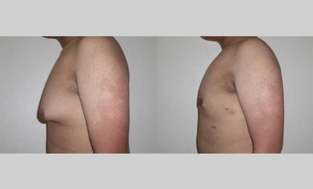 Male Breast Reduction: Image #251