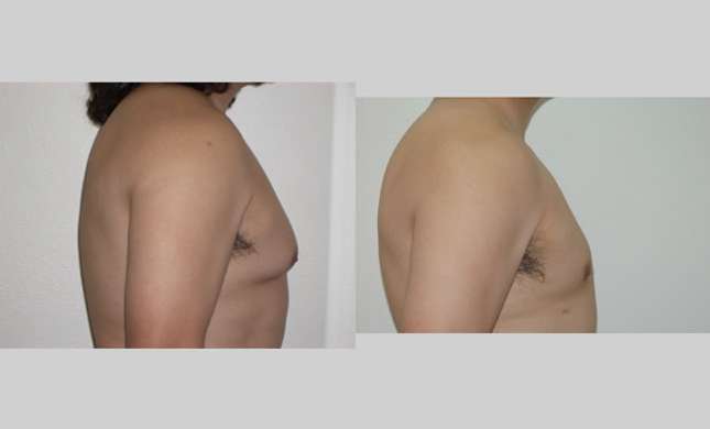 Male Breast Reduction: Image #252
