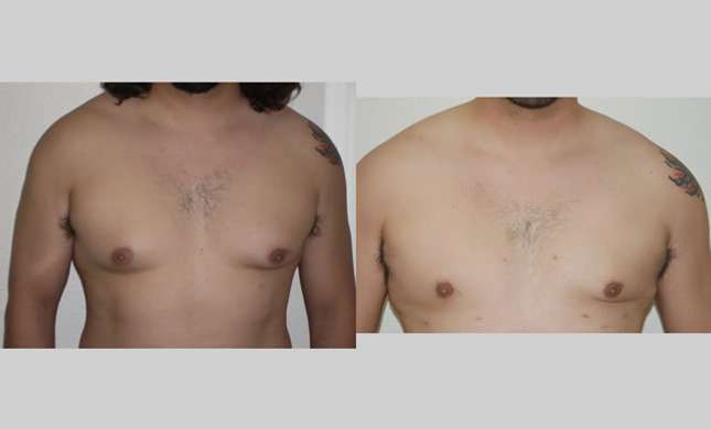 Male Breast Reduction: Image #253