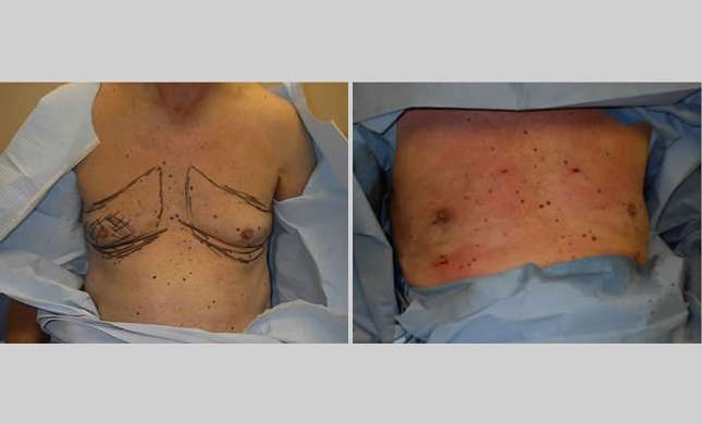 Male Breast Reduction: Image #254