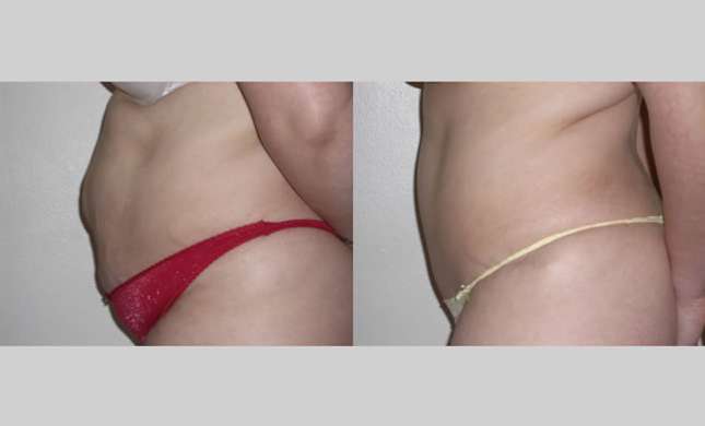 Tummy Tuck: Image #259