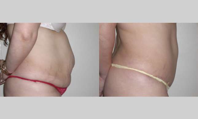 Tummy Tuck: Image #260